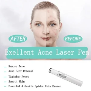 Blue Light Therapy Varicose Veins Pen