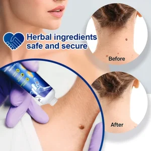 Wart Remover, Instant Blemish Removal Gel, Skin Wart Removal Cream