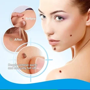 Wart Remover, Instant Blemish Removal Gel, Skin Wart Removal Cream