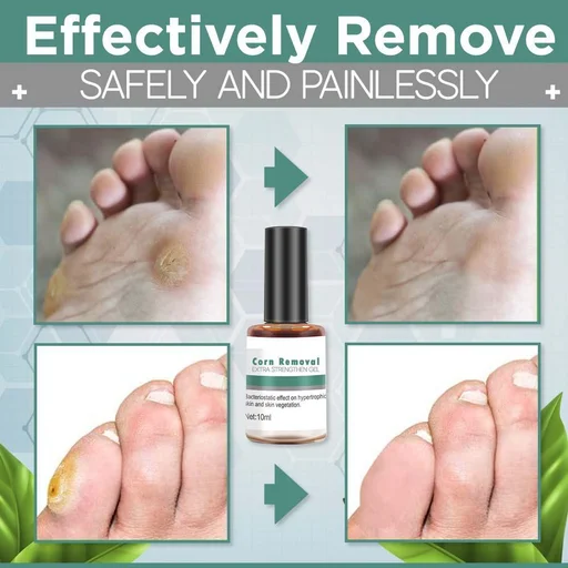 How to Remove Corns and Calluses Naturally, StethNews