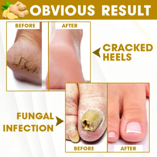 Anti-Fungal Callus Detox Patch