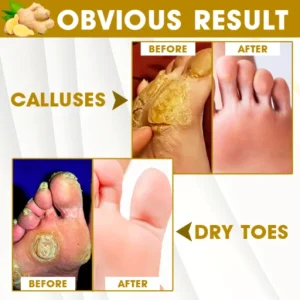 Anti-Fungal Callus Detox Patch