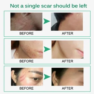 Skin Rebound Scarless Cream