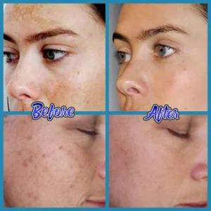 Anti-Blemish Facial Cream