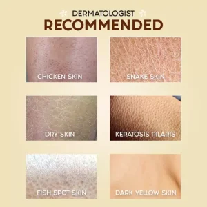 Keratosis Pilaris Repair Cream