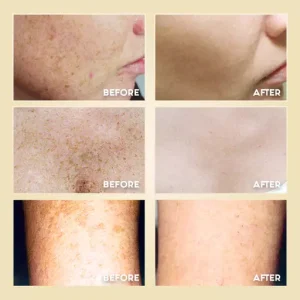 Keratosis Pilaris Repair Cream