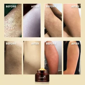 Keratosis Pilaris Repair Cream