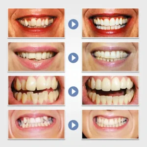 Dental Appliance Tooth Orthodontic Braces Trainer Dental Braces Teeth Trainer Alignment Braces