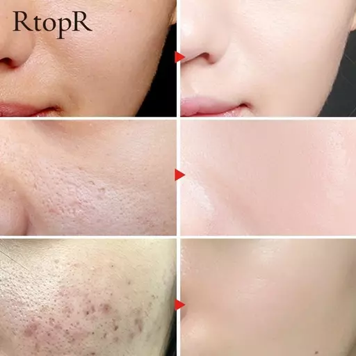 RtopR Glycyrrhiza Face Pore Repair Serum