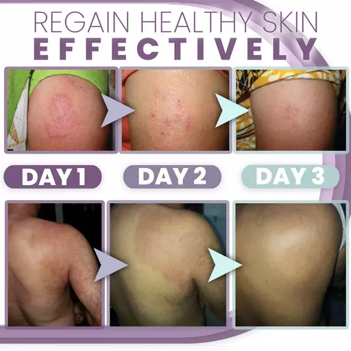 3 Days Anti Fungal Rash Cream