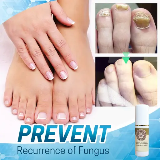 Anti-Fungal Treatment Spray