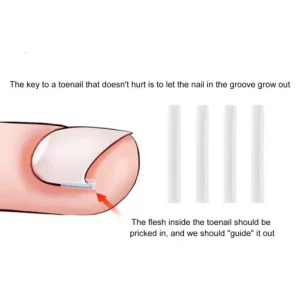 Ingrown Toenail Correction Tool