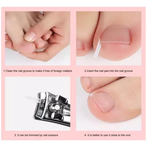 Ingrown Toenail Correction Tool