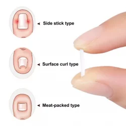 Ingrown Toenail Correction Tool