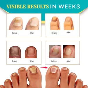 NailRenew Anti-Fungal Treatment Set