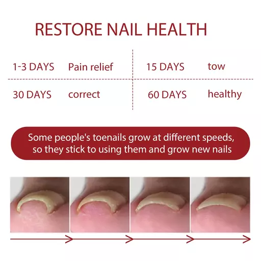 Anti Paronychia Relief Oil Ingrown Toenail Drops