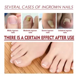 Anti Paronychia Relief Oil Ingrown Toenail Drops