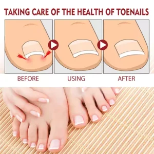 Anti Paronychia Relief Oil Ingrown Toenail Drops