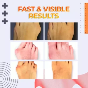 Drto™️ Bunion Splint Corrector