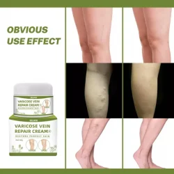 Varicose Vein Repair Cream