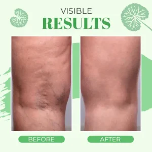 VeinoPro Varicose-Veins Treatment Soap