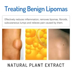South Moon Lipoma Removal Cream