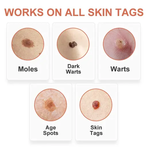 GFOUK™ WipeOff Tags and Moles Eliminator