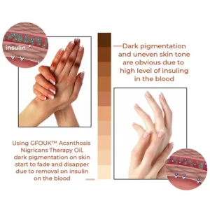 GFOUK™ Acanthosis Nigricans Therapy Oil