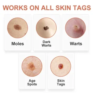 GFOUK™ WipeOff Tags and Moles Eliminator