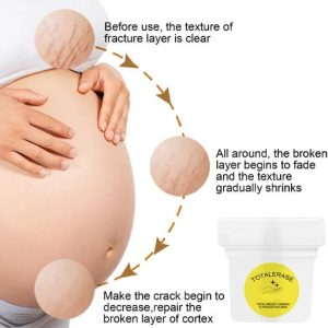Anti-Stretch Marks Turmeric Fading Cream