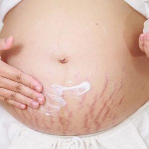 Anti-Stretch Marks Turmeric Fading Cream