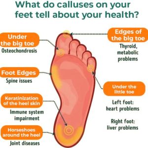 GFOUK™ Foot Callus Removal Spray