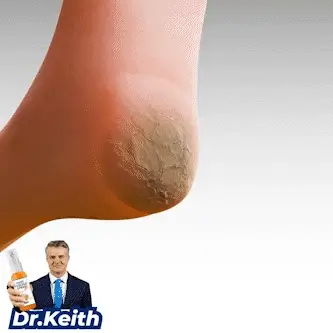GFOUK™ Foot Callus Removal Spray