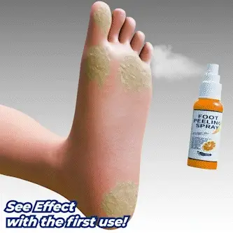 GFOUK™ Foot Callus Removal Spray