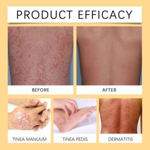 South Moon Bee Venom Psoriasis Caring Cream