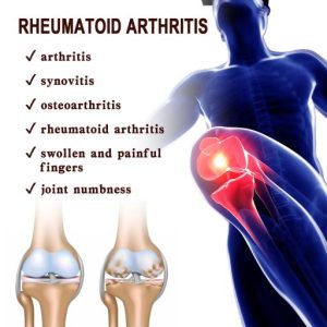 South Moon Rheumatoid Arthritis Miracle Cream
