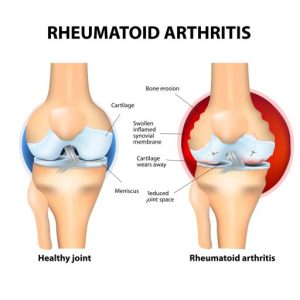 South Moon Rheumatoid Arthritis Miracle Cream