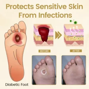 Timilk® Diabetic Foot Healing Spray - Bee Venom Infused