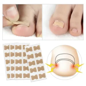 Toe Align Ingrown Nail Corrector Stickers