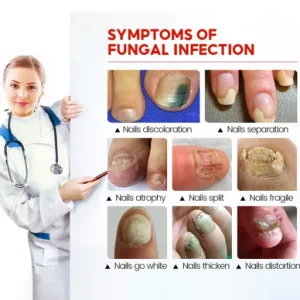 CVREOZ® Bee Venom Nail Fungus Spray