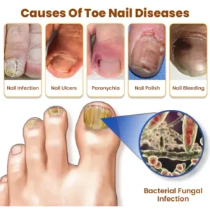 CVREOZ® Bee Venom Nail Fungus Spray