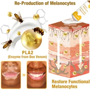 LOVILDS™ Bee Venom Vitiligo Treatment Cream