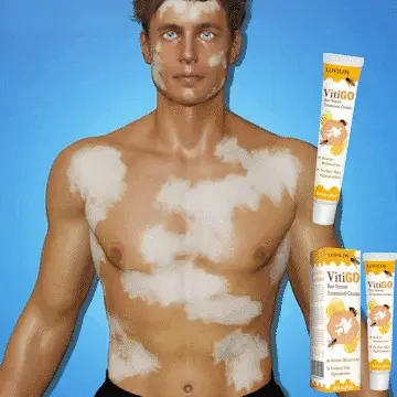 LOVILDS™ Bee Venom Vitiligo Treatment Cream
