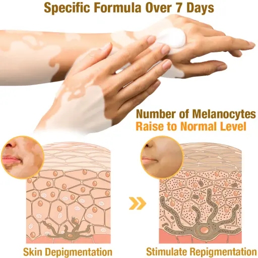 LOVILDS™ Bee Venom Vitiligo Treatment Cream