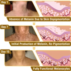 LOVILDS™ Bee Venom Vitiligo Treatment Cream