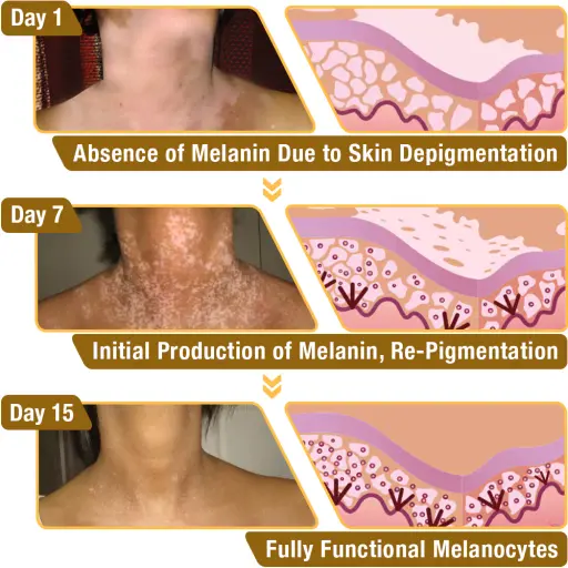 LOVILDS™ Bee Venom Vitiligo Treatment Cream