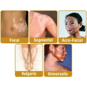 LOVILDS™ Bee Venom Vitiligo Treatment Cream