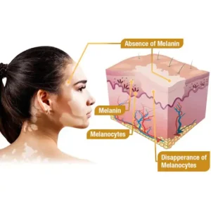 LOVILDS™ Bee Venom Vitiligo Treatment Cream