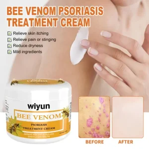 Cvreoz® Bee Venom Psoriasis Treatment Cream