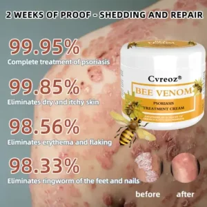 Cvreoz® Bee Venom Psoriasis Treatment Cream